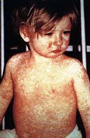 Measles Outbreak in Western Canada