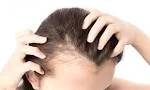 Hair Loss in Adults
