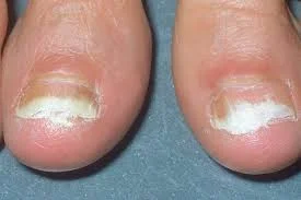 Toe Nail Fungus