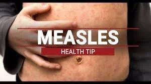 Measles Update