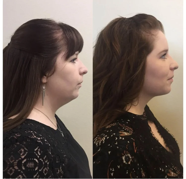 Have You Heard About Kybella?