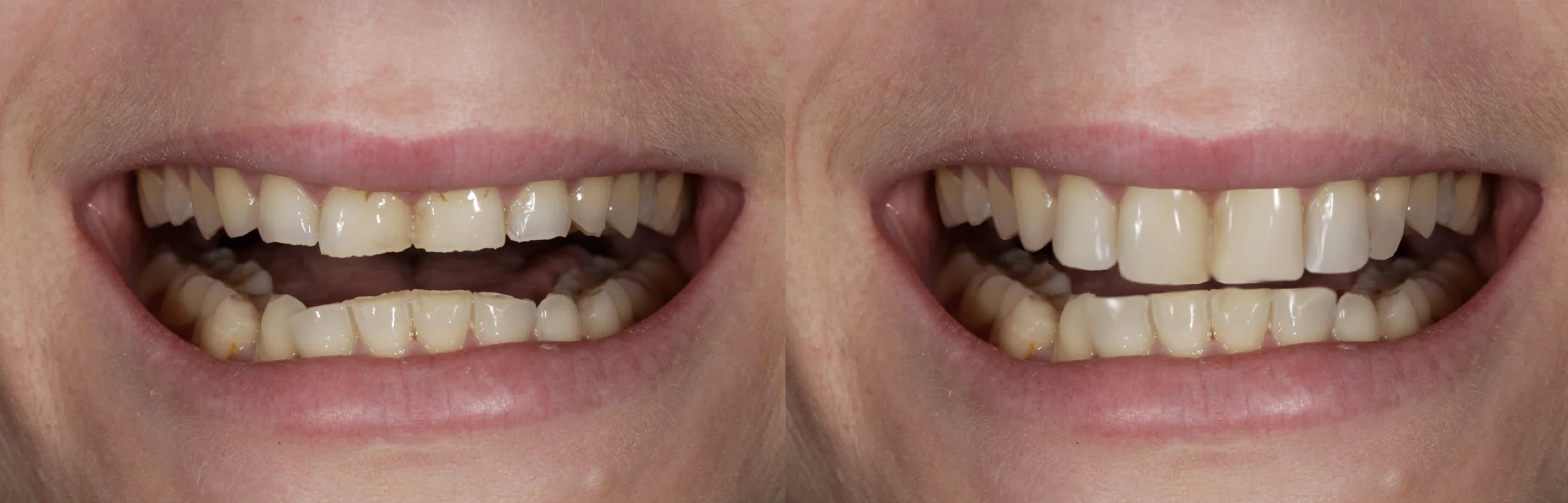 Computer simulation to show patient what might be possible with composites or veneers