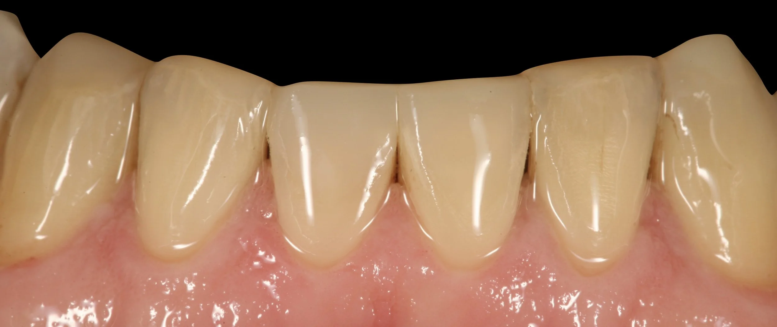 DENTER ANTERIOR COMPOSITES.004.jpeg