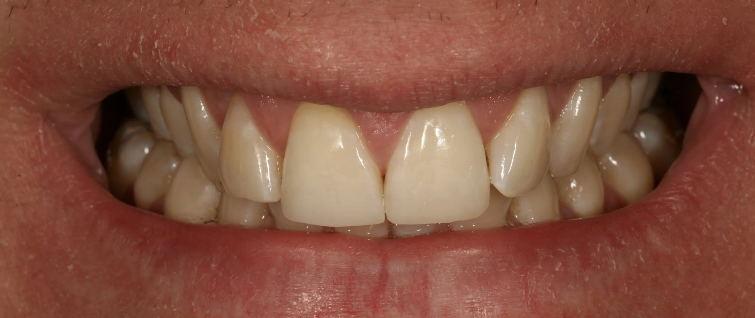 DENTER ANTERIOR COMPOSITES.007.jpeg