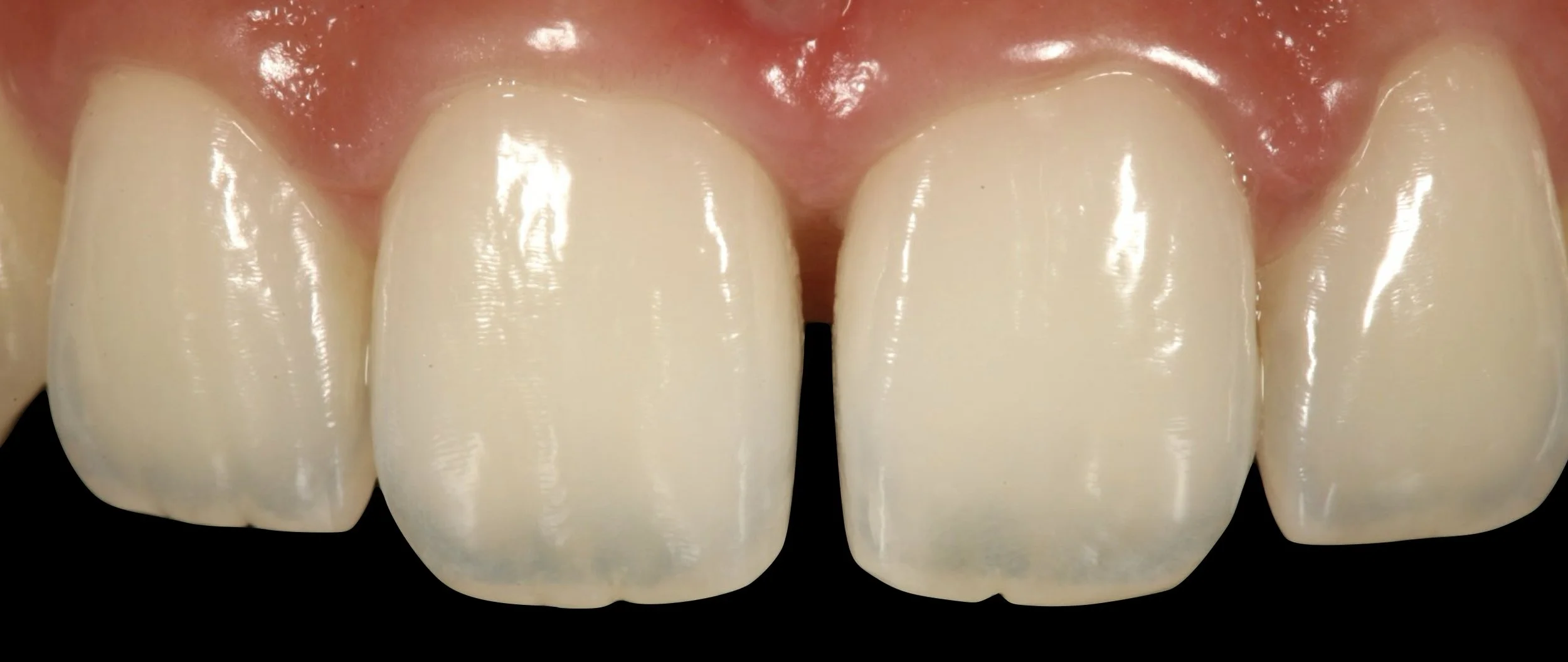 DENTER ANTERIOR COMPOSITES.001.jpeg