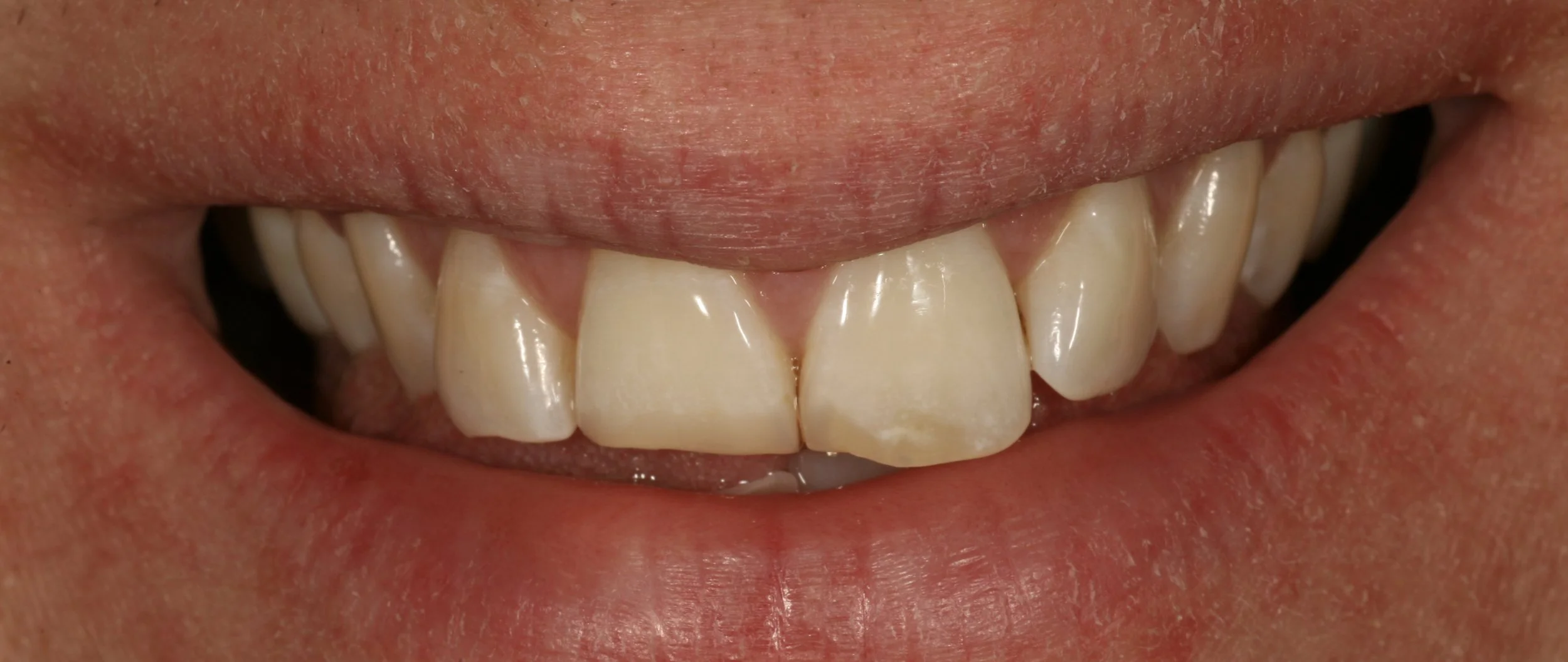 DENTER ANTERIOR COMPOSITES.008.jpeg
