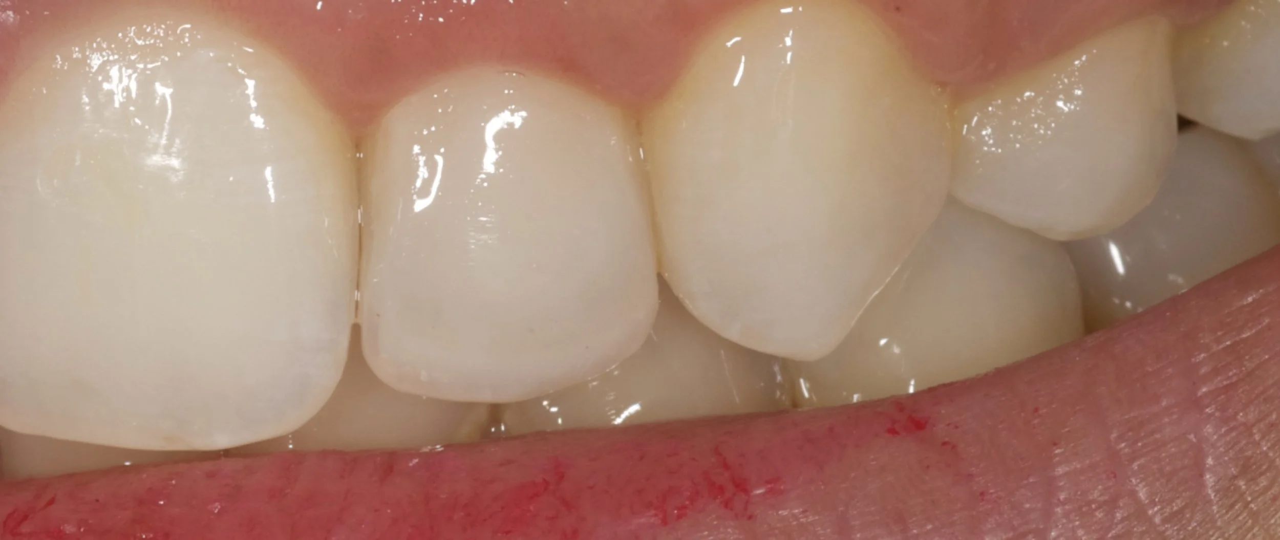 DENTER ANTERIOR COMPOSITES.006.jpeg