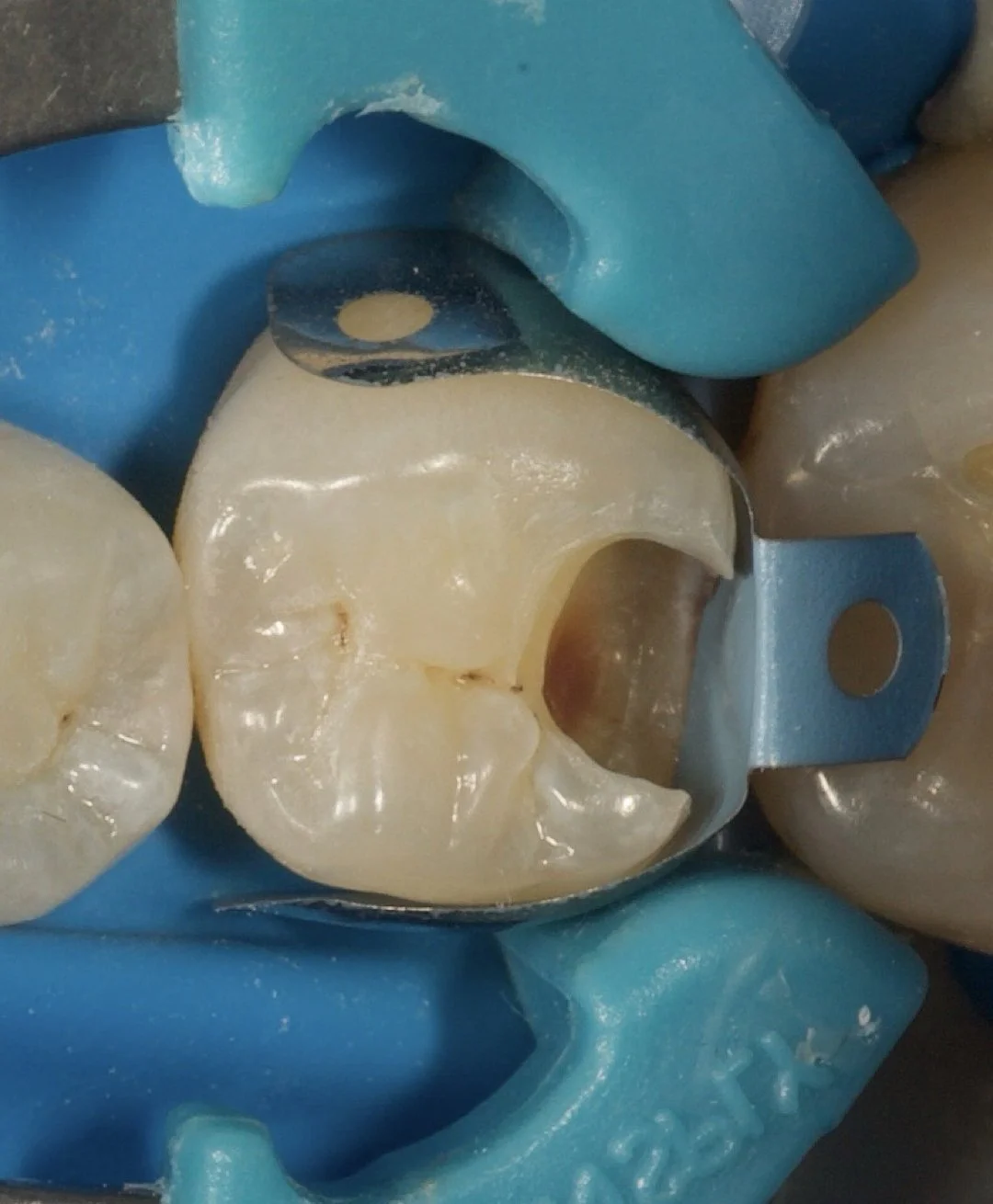 POSTERIOR COMPOSITES | New Dates Coming Soon