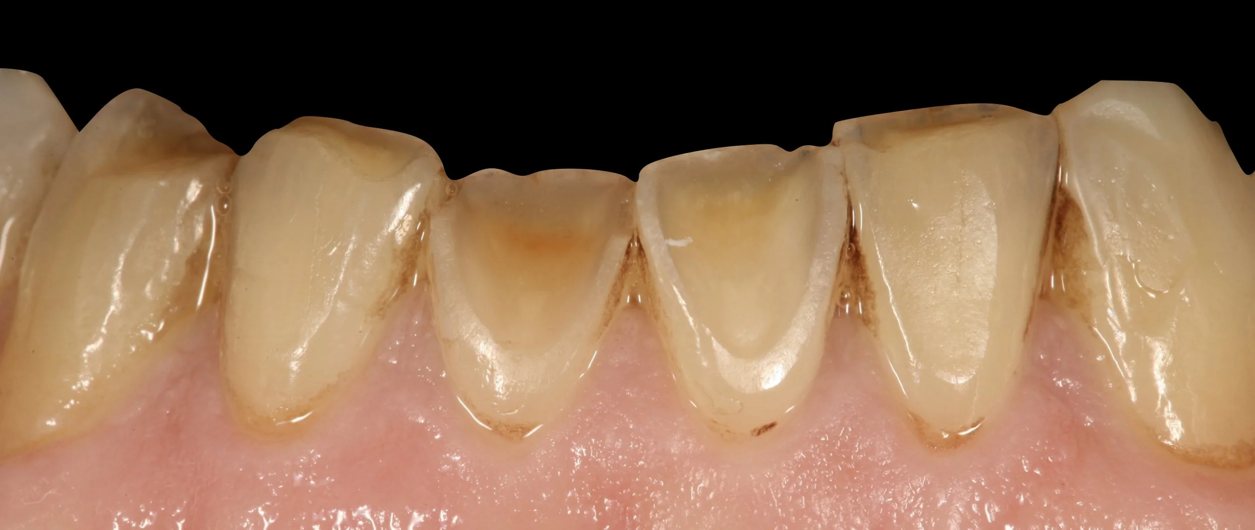 DENTER ANTERIOR COMPOSITES.003.jpeg