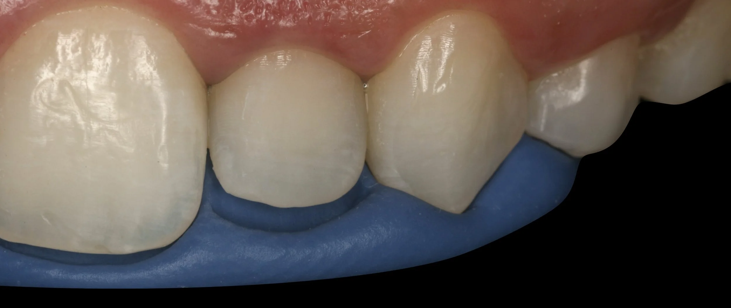 DENTER ANTERIOR COMPOSITES.005.jpeg