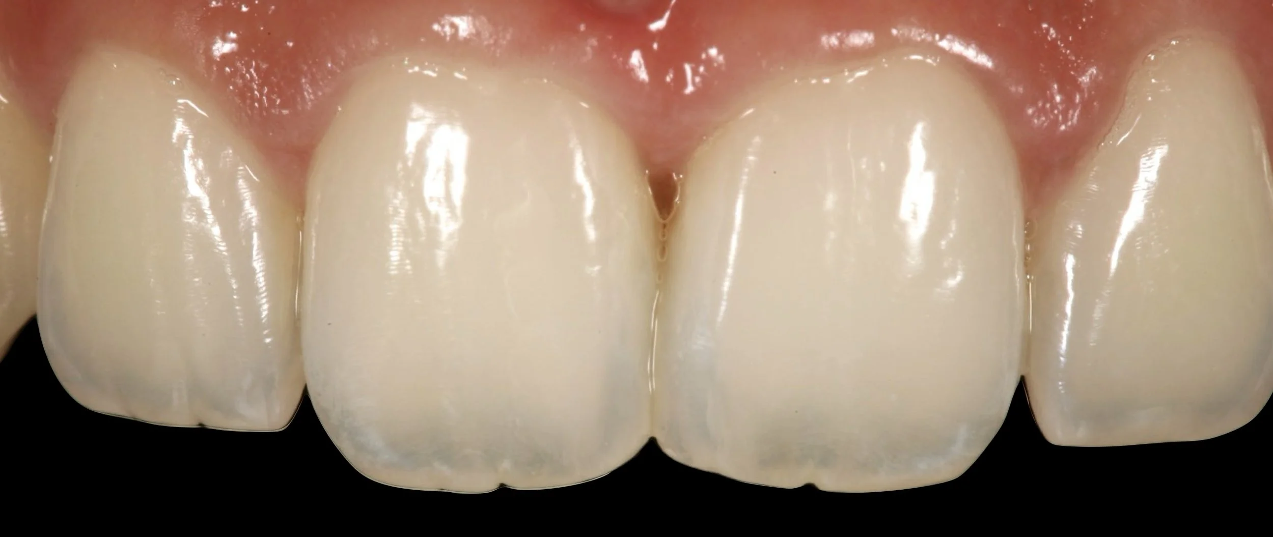 DENTER ANTERIOR COMPOSITES.002.jpeg