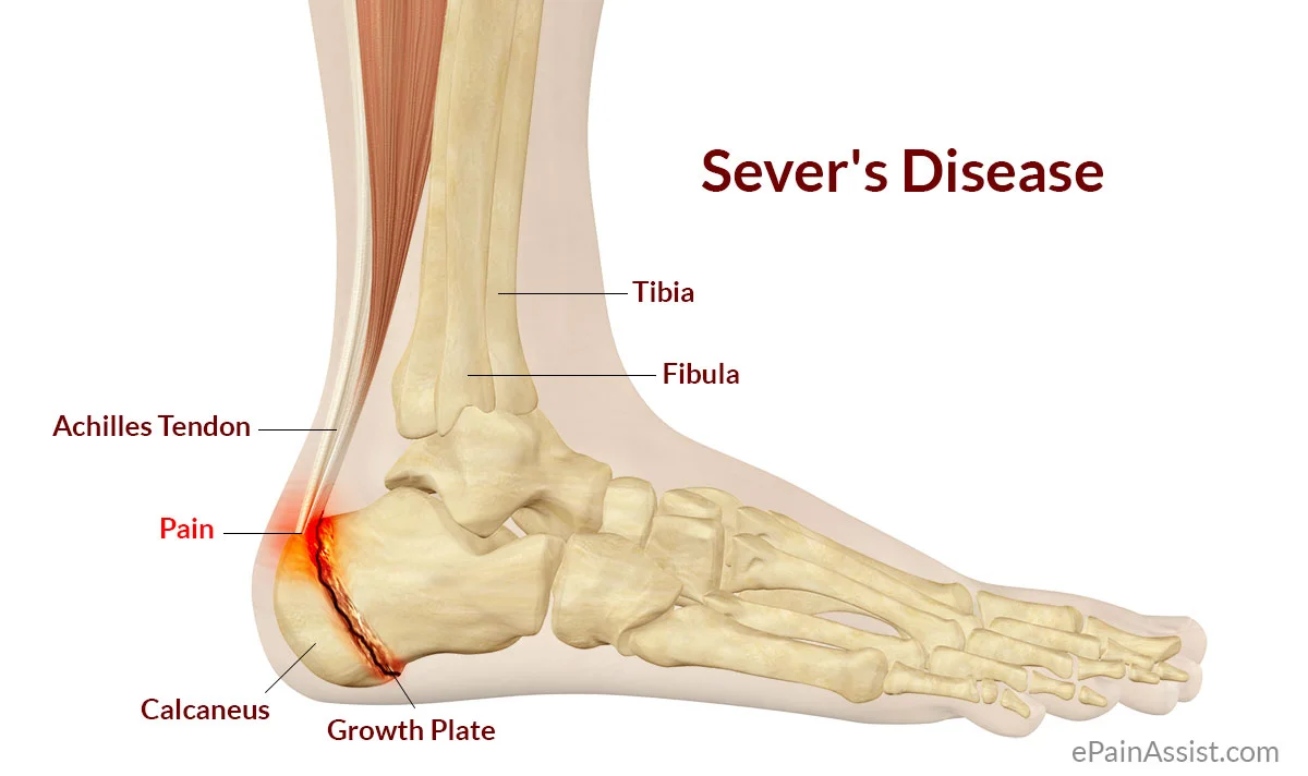 Sever-Disease.jpg