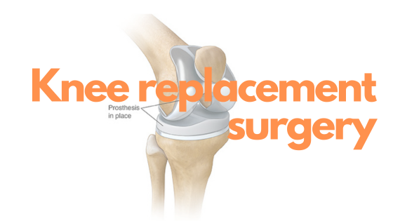 Do I need Physiotherapy after Knee Joint Replacement Surgery?