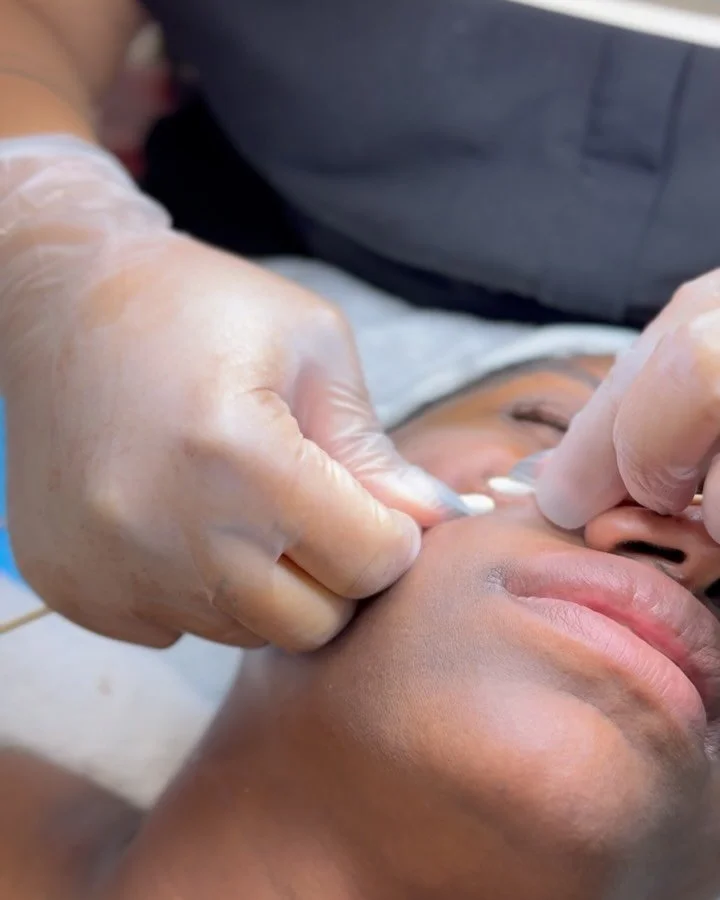 Be honest&hellip; did you flinch or smile watching these extractions? 👀

Rate these extractions below 1 being &lsquo;ouch&rsquo; and 10 being &lsquo;pure satisfaction&rsquo; 

PSA: Britt &amp; Tam are now booking for December!
Get in early and secur
