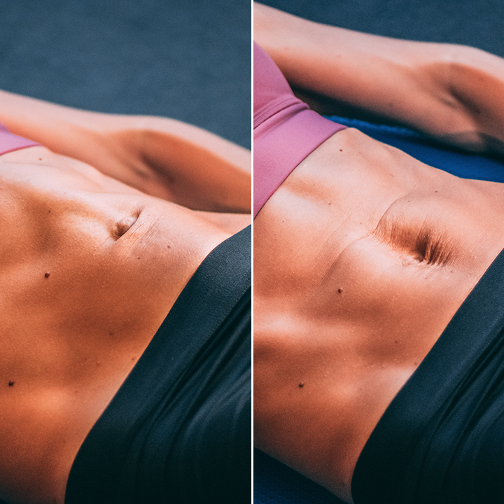 Diastasis Recti Fix (PDF)