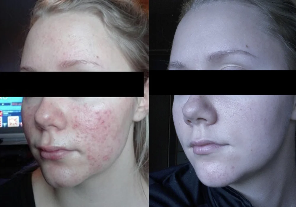 Acne Rosacea