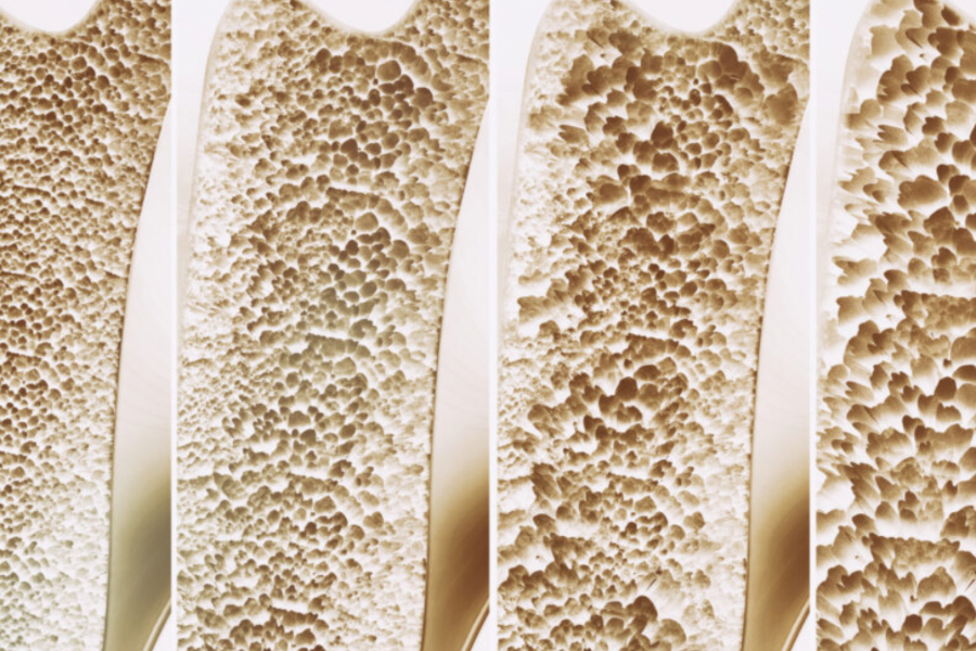 Can Yoga Alone Prevent or Reverse Osteoporosis?