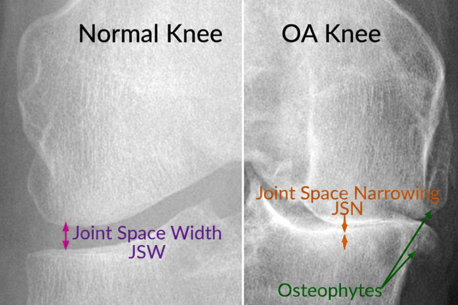 Does Being Active (Including Practicing Yoga) Wear Out Our Joints?