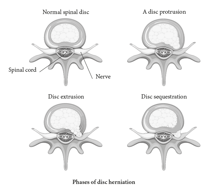 Inoperable Disc Why our intervertebral discs cannot slip! — Doctor Yogi