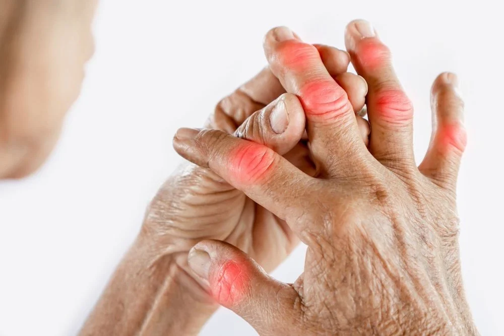 Rheumatoid Arthritis Hands