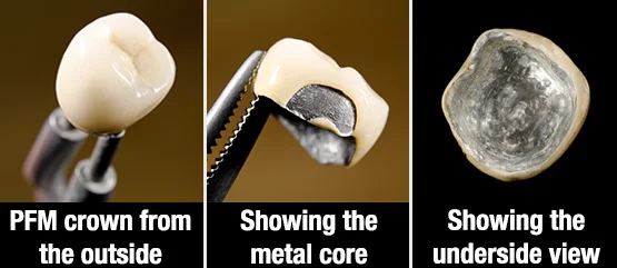 PFM porcelain fused metal crowns.jpg
