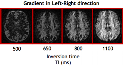 Inversion-recovery prepared diffusion-weighted images.