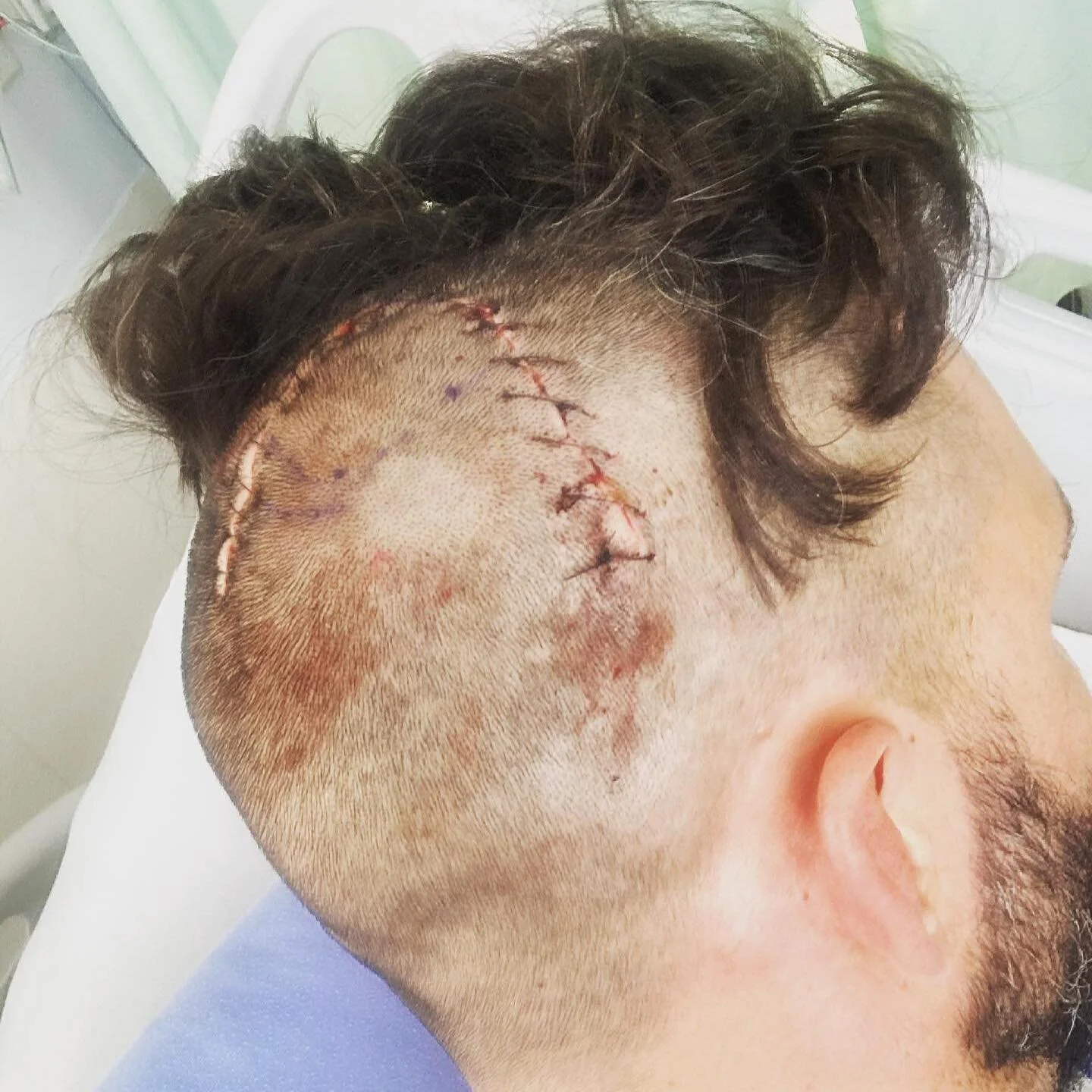-The skull is a little sore today but I&rsquo;m happy to be alive and thankful for modern medical science, hospitals, nurses and all the support from people out there; family, friends and strangers!- a big thanks to all. And a special thanks to my ma