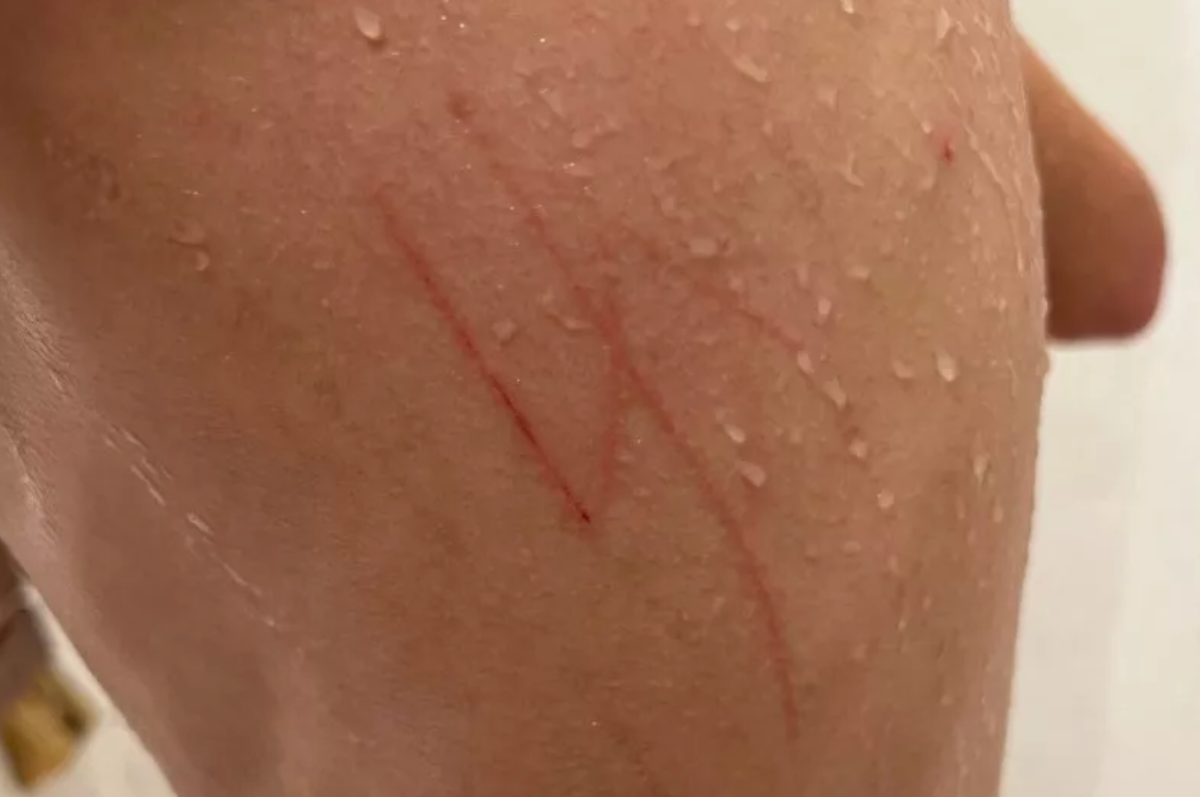 Lawfare Project represents student who returned home from school with swastika carved into his back