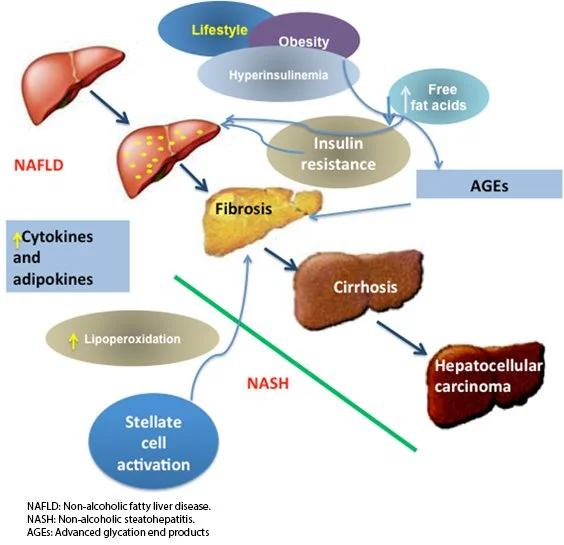 Fatty Liver and How to Fix It Naturally