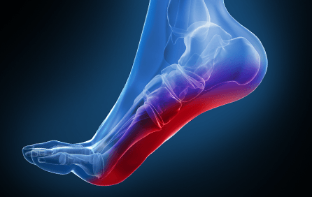 custom-orthotics-Plantar_fasciitis.png