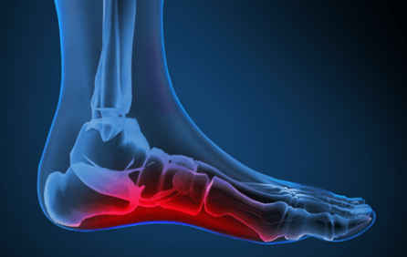 custom-orthotics-over_pronation.png