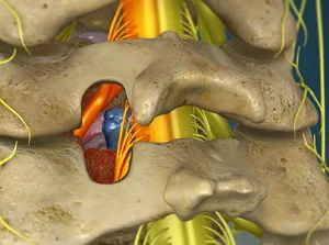 Cervical-Posterior-Foraminotomy.jpg