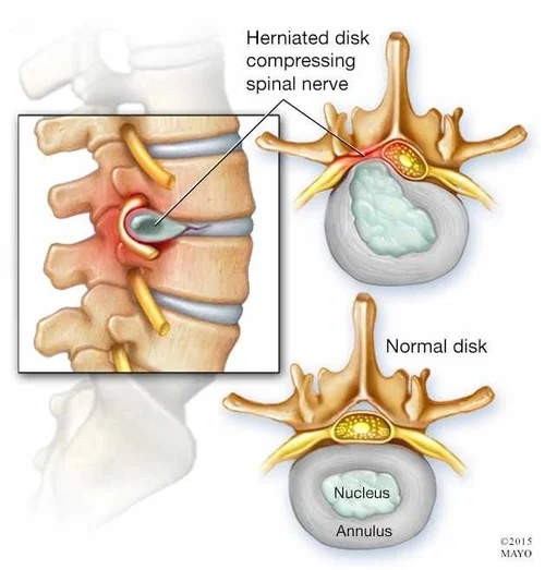 Essentials Of A Disc Herniation Bulging Discs Physiotherapists In Toronto Yorkville Sports Medicine Clinic
