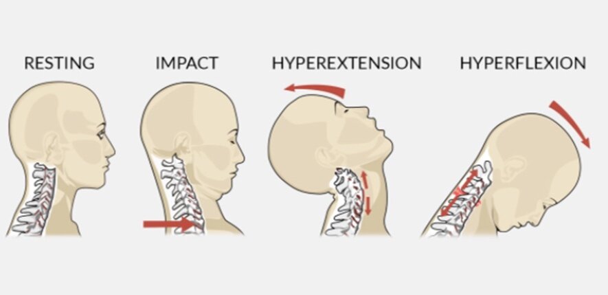 The 8 BEST Stretches & Exercises For Whiplash Injury