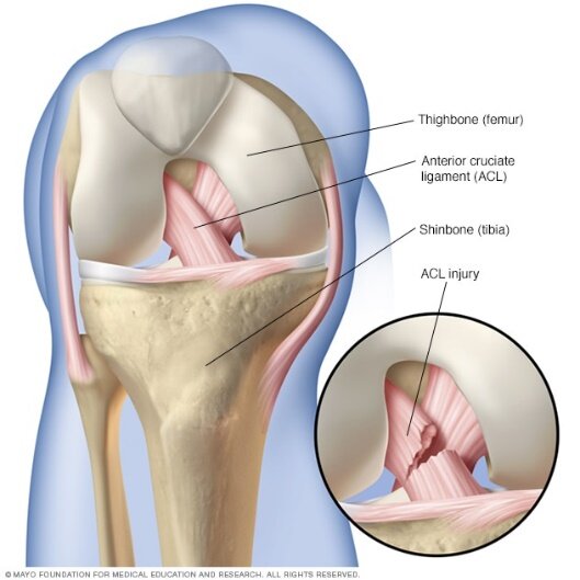 ACL Rehabilitation Protocol: What to do after surgery, Physiotherapists in  Toronto
