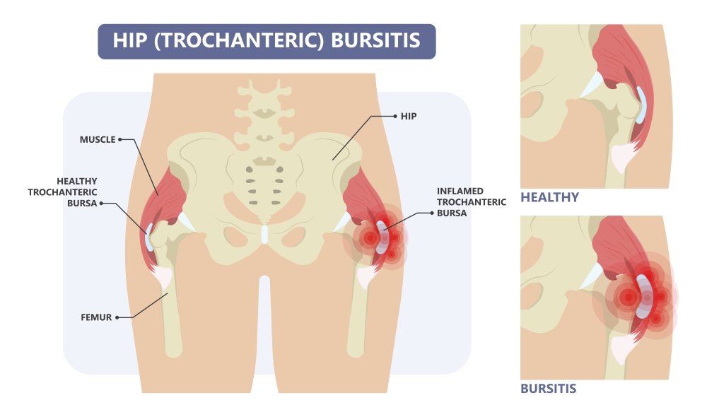 Hip Bursitis - Pro Motion Physiotherapy Thornhill