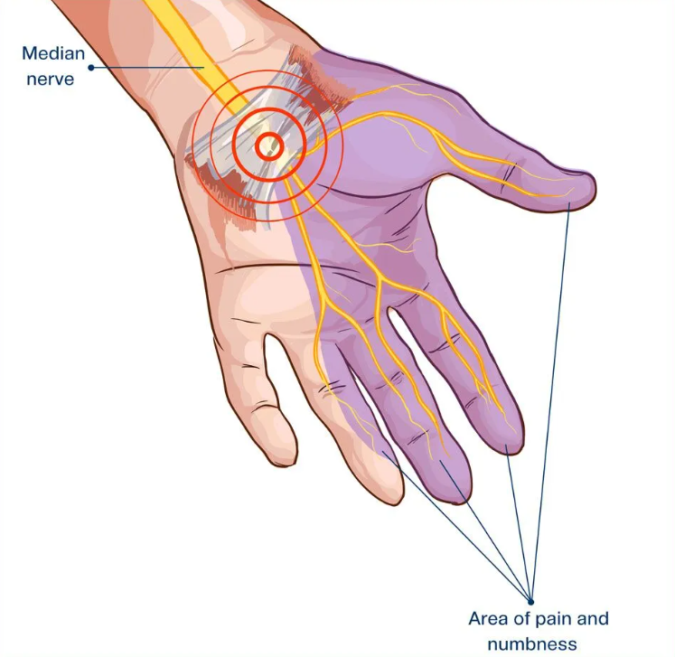 Diminished Hand Sign 7 Common Causes of Finger Numbness and What They Mean ...