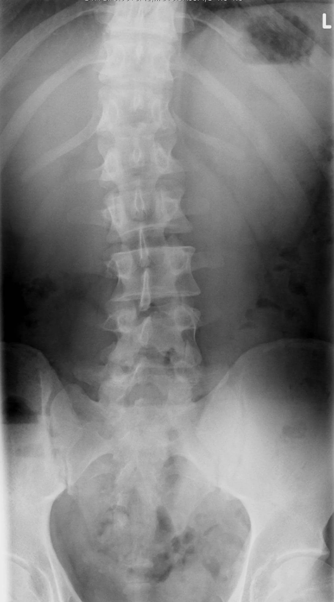 Scoliosis.jpg