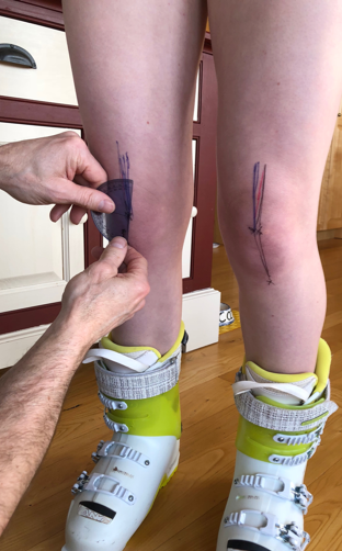Figure 3. Measuring Q-angle in custom ski boots.