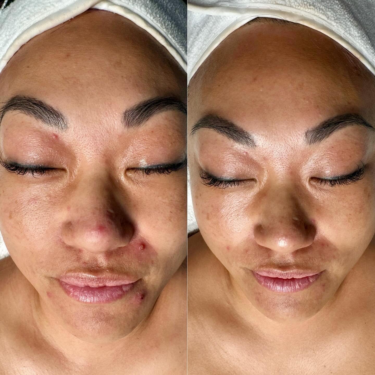 〰️ @dmkinternational and just getting started 🥳 before and after photos are within 2 weeks of each other, one taken April 23, and the right May 8. This is after getting one Enzyme Treatment to address Acne congestion. Followed up with her second tre