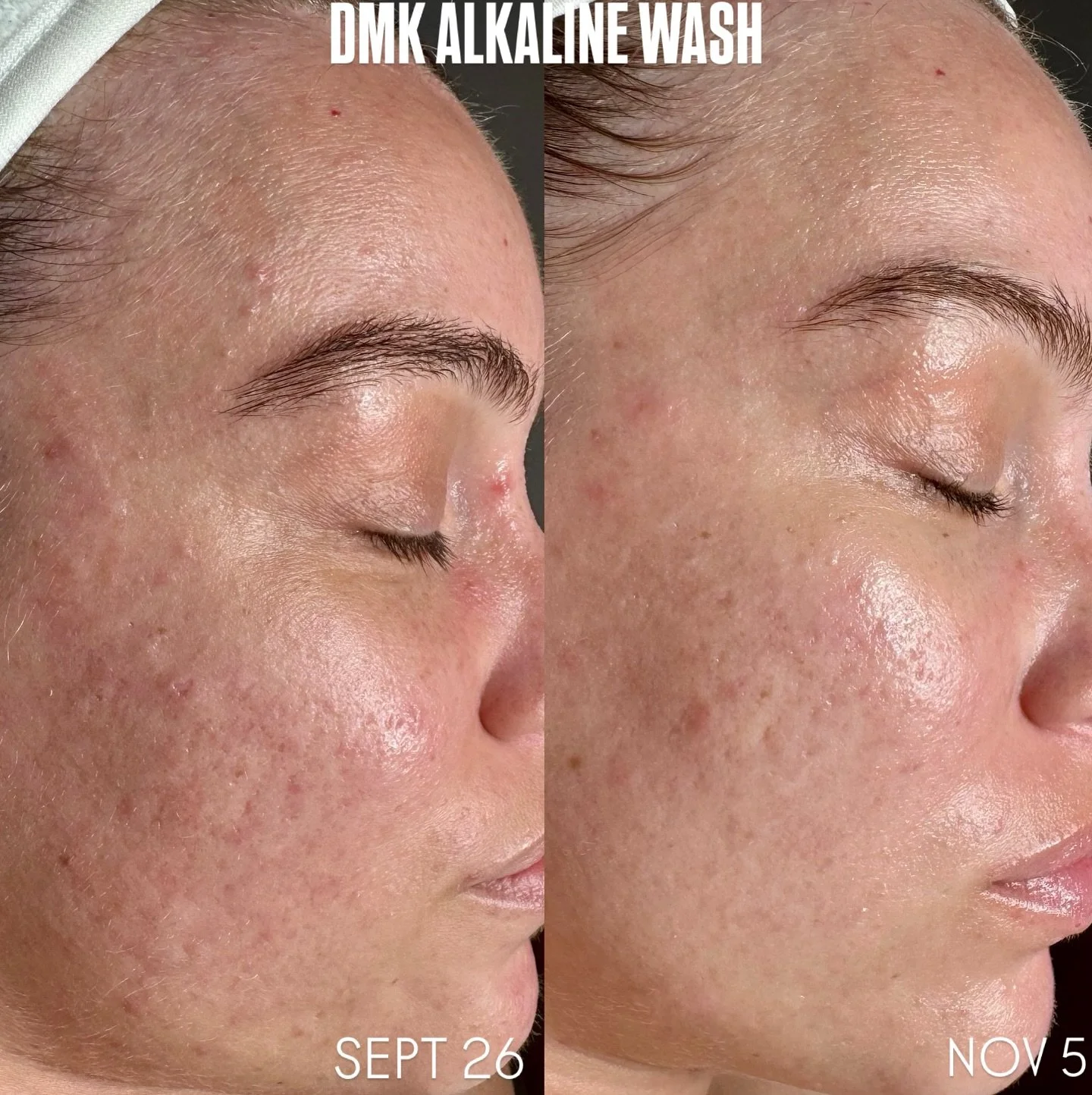 DMK ALKALINE WASH 🧪

One of my favorite things to work with when doing skin correction work. Often noticeable results after one treatment. Better results with a few. 

DMK Alkaline Wash is a skin treatment that temporarily raises the skin&rsquo;s pH