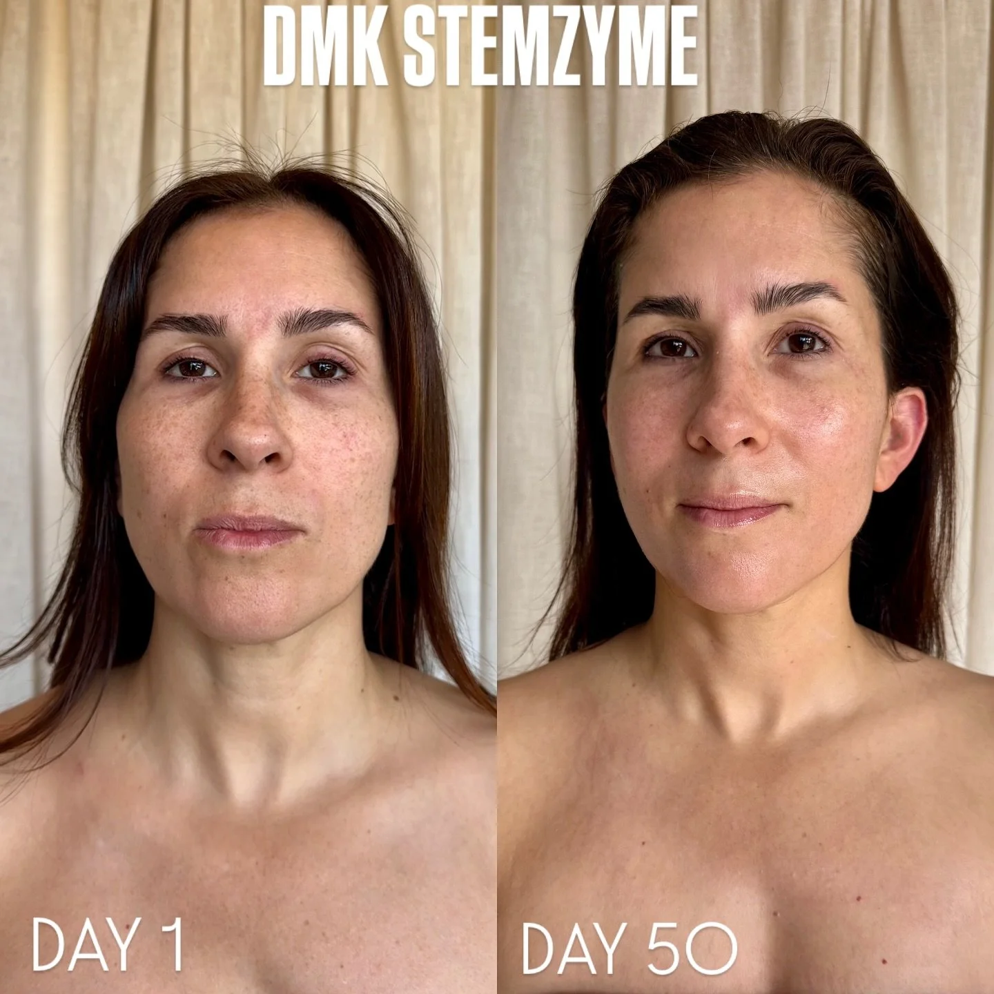 🌲CHRISTMAS came early for my beautiful client who recently underwent @dmkinternational STEMZYME. 

She was generous in letting me share the results, cos they are stunning for the 50 days we did this non-invasive skin revision reboot. ☺️💛

StemZyme 