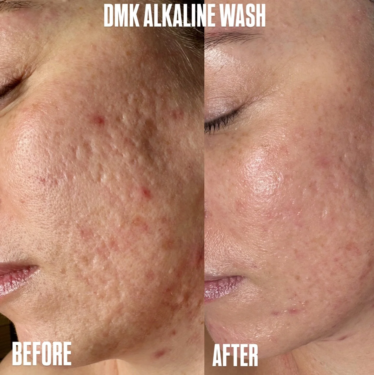 Skin texture revision doesn&rsquo;t have to be invasive or painful, thanks to @dmkinternational&rsquo;s innovative treatment Alkaline wash. 

Minimal to no downtime. Most will experience temporary dryness, possible light scabbing for a few days, then