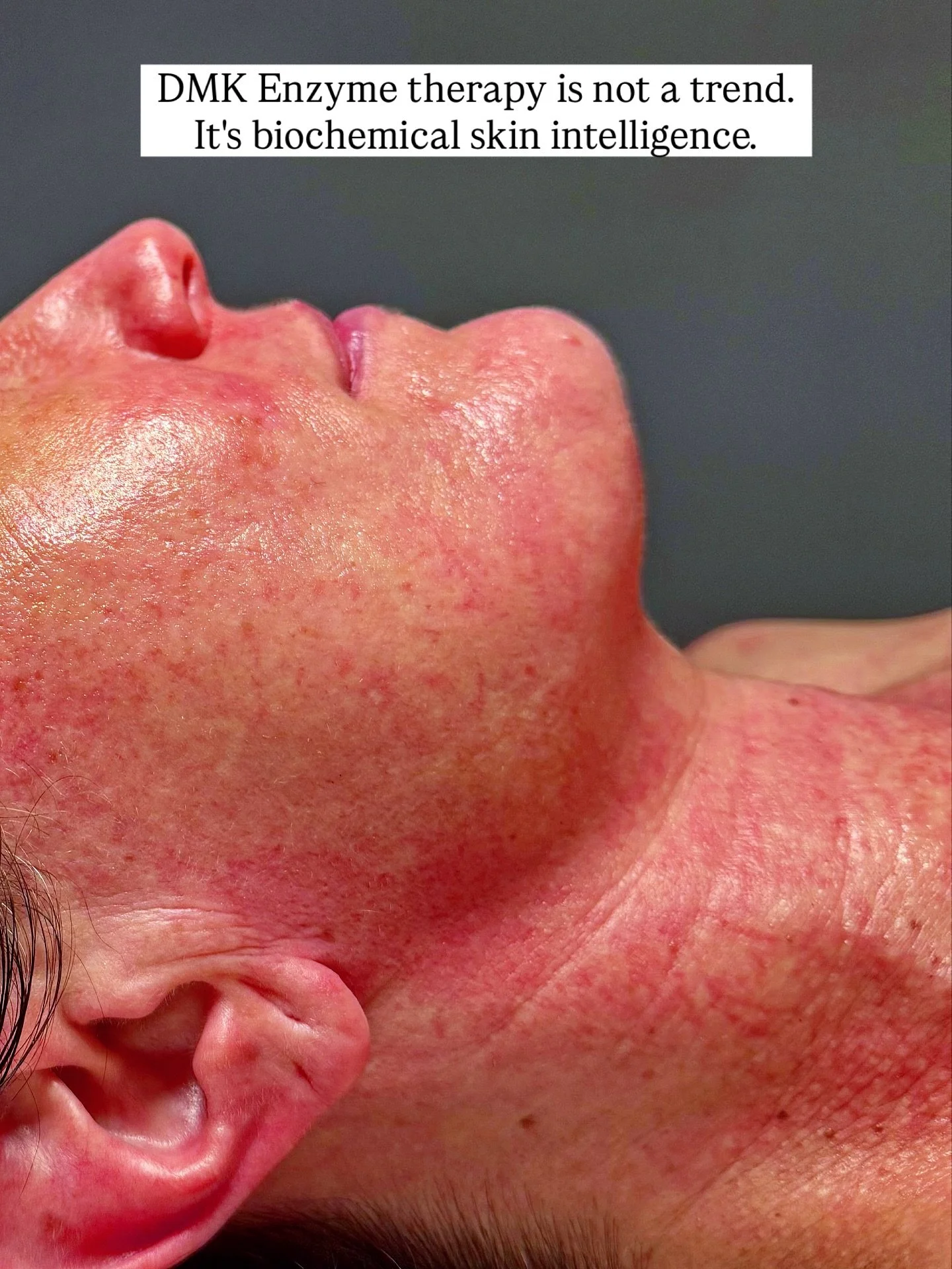 The @dmkinternational Plasmatic Effect is a temporary, visible, red &ldquo;road map&rdquo; of capillary dilation, appearing on the skin&rsquo;s surface after an enzyme treatment, indicating increased circulation, oxygenation, and lymphatic drainage. 