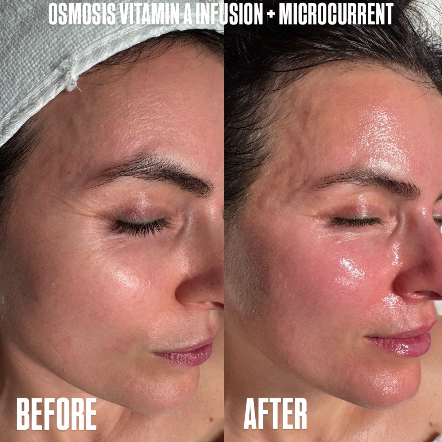 Skin luminosity with a Mobetta Beauty LA classic of @osmosisbeauty Vitamin A infusion + the power of microcurrent. 

A stunning combination for skin rejuvenation. Custom tailored to address the signs of aging, and turn to a beautiful healthy glow, an