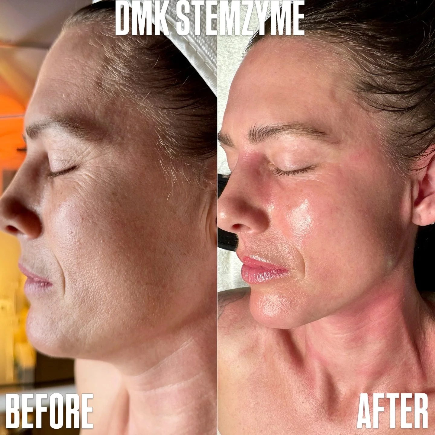 Reverse the hands of time with @dmkinternational innovative and non-invasive Age Management treatment: StemZyme. 

🔋 StemZyme is a 50 day skin boot camp treatment developed by DMK that utilizes the body&rsquo;s own epidermal stem cells to rejuvenate