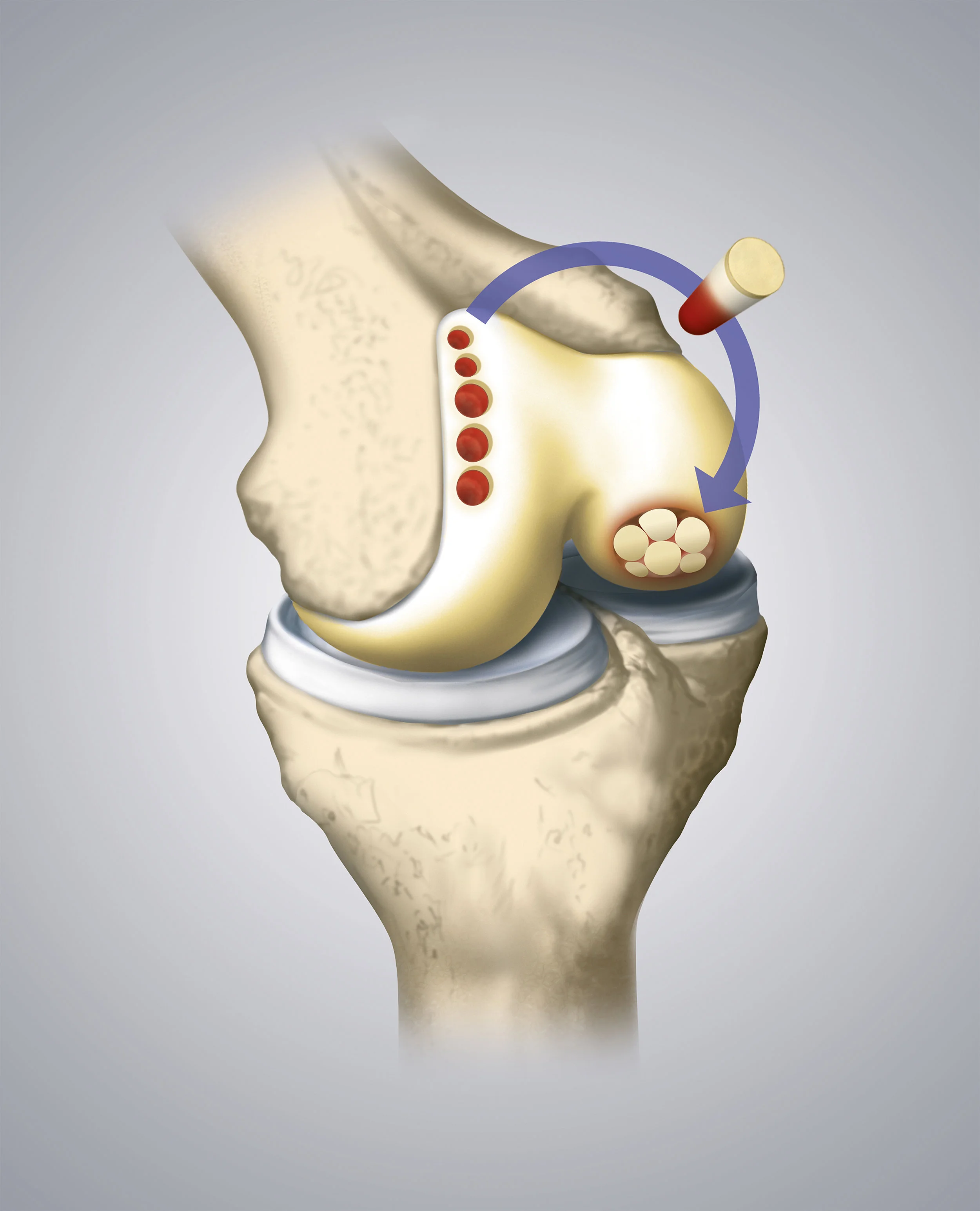Cartilage Restoration — Adam B. Cohen, MD