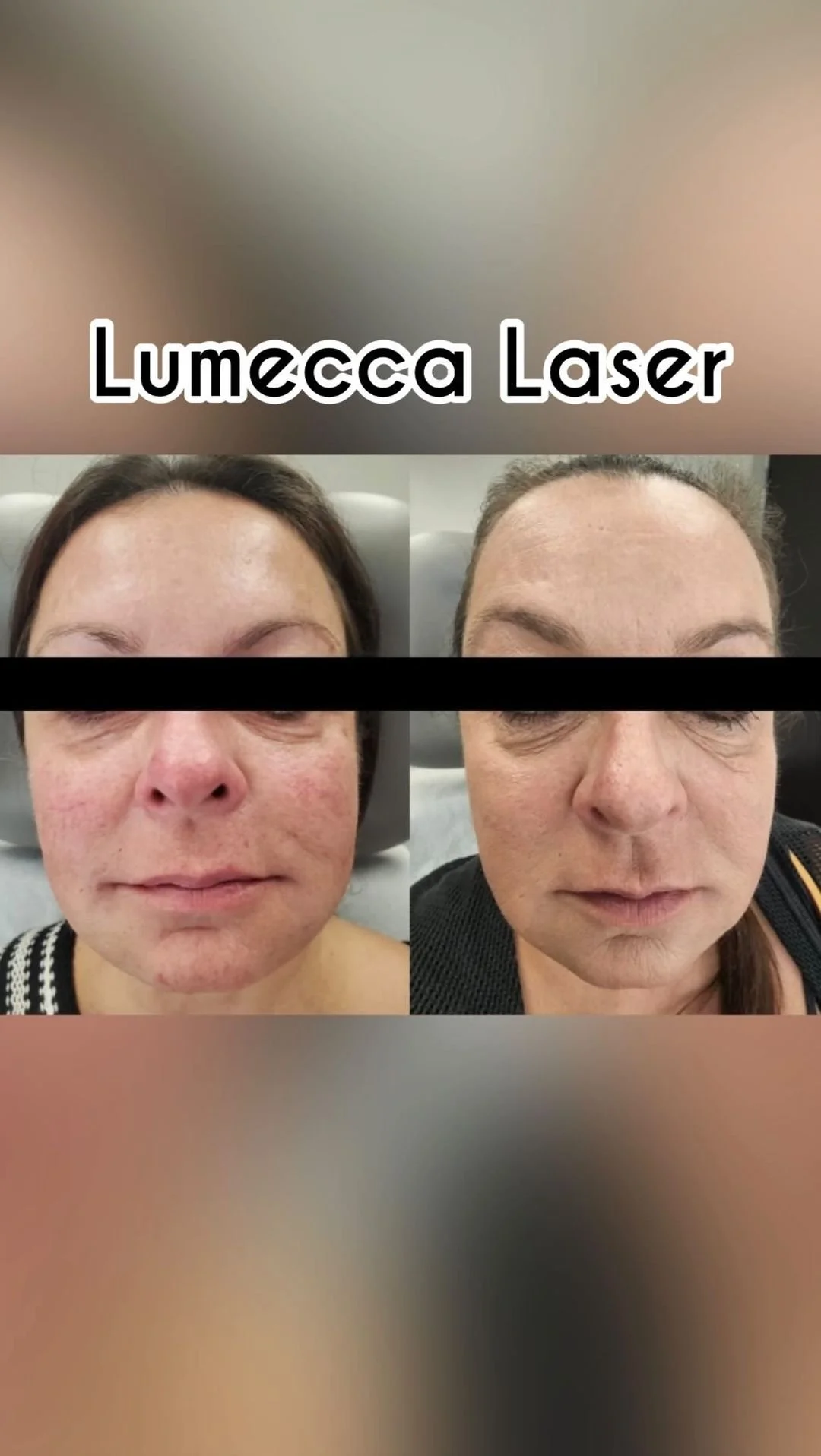 LUMECCA LASER