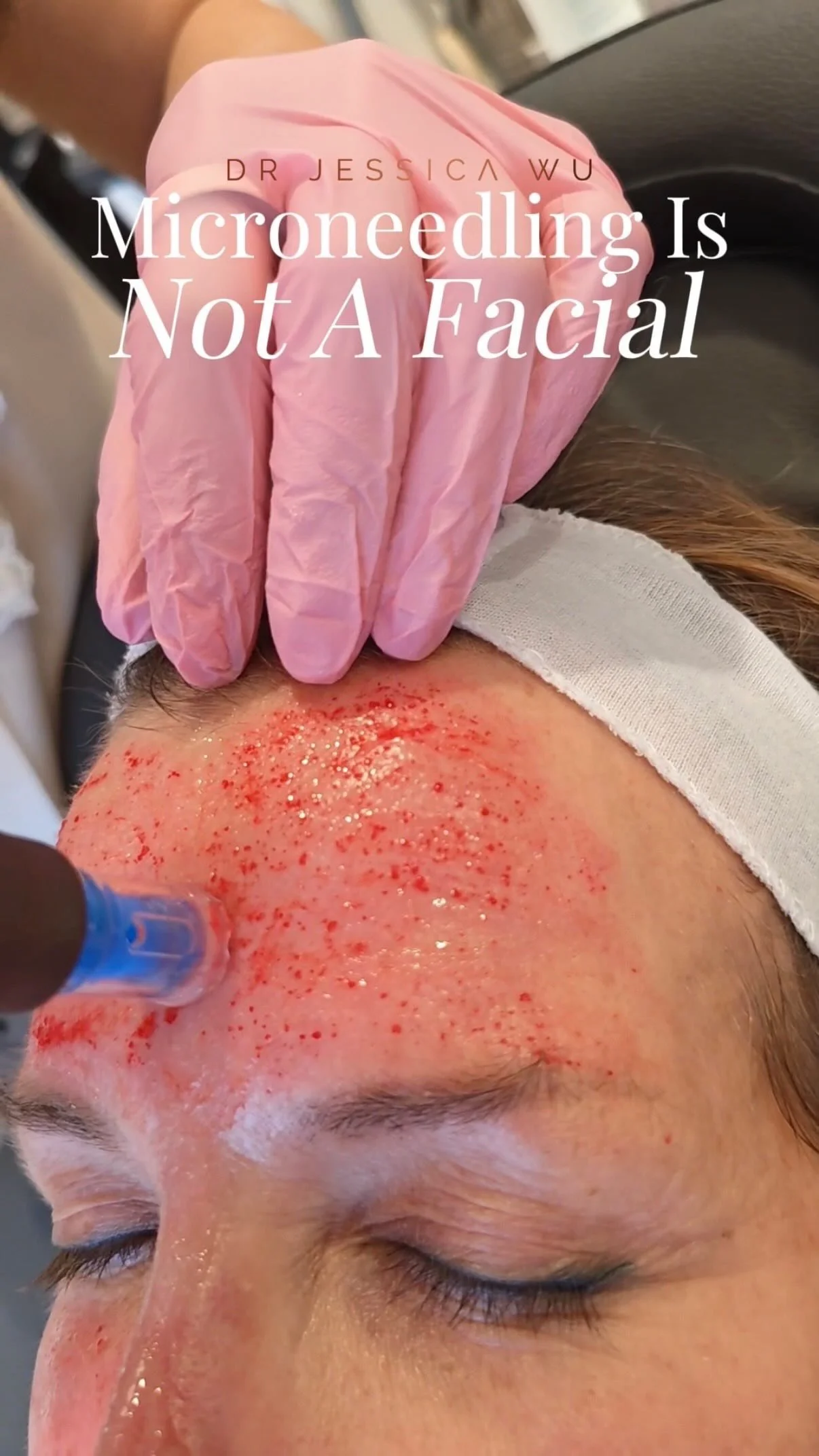 Microneedling is NOT a Facial