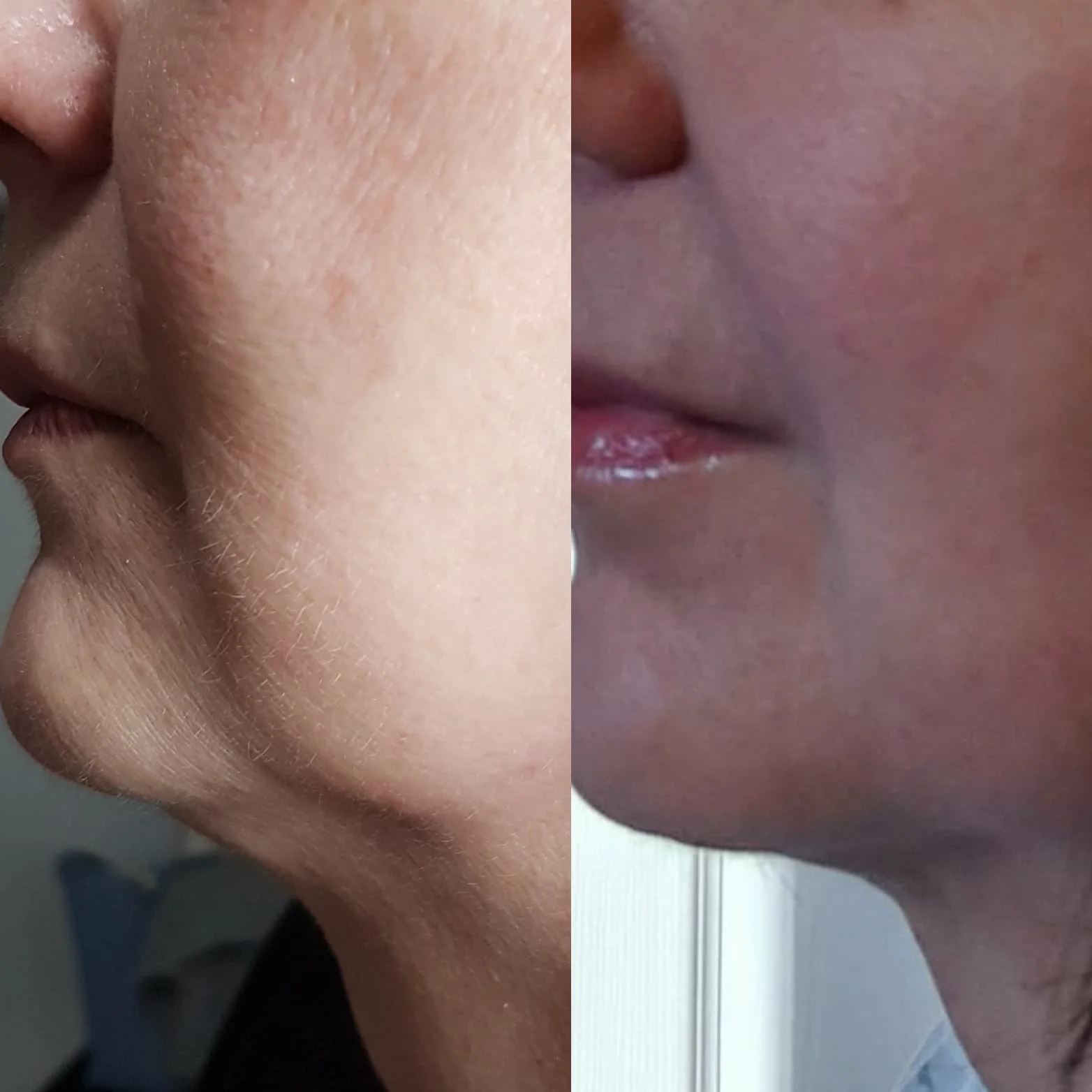 BEFORE AND 4 WEEKS AFTER